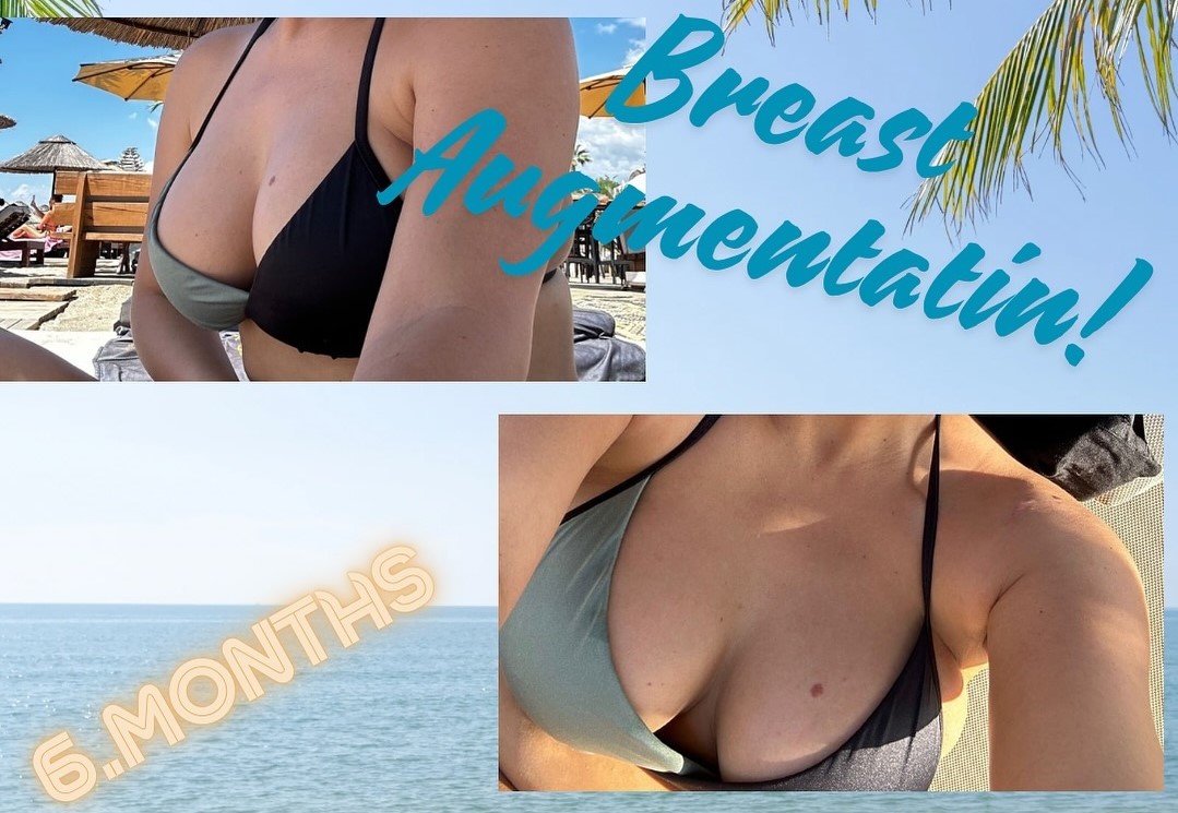 Breast augmentation in turkey, antalya