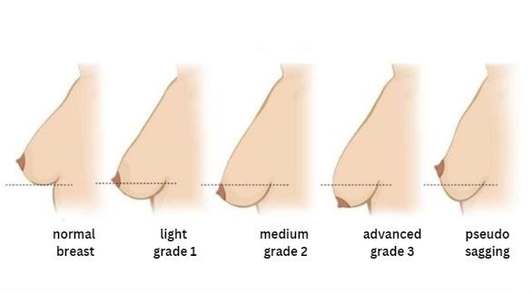 sagging-breast-levels in turkey, antalya