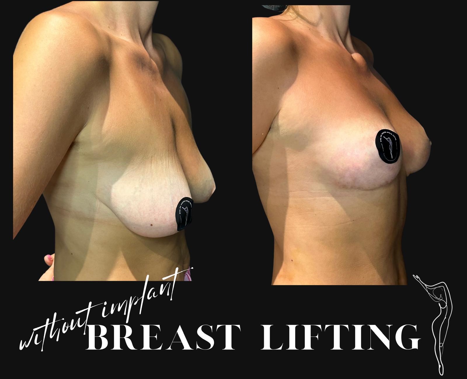 How is Breast Lift (Mastopexy) Surgery Done? Recovery after Breast Lift in turkey, antalya