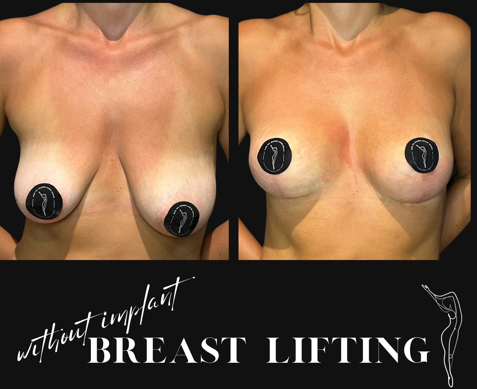 How is Breast Lift (Mastopexy) Surgery Done? Recovery after Breast Lift in turkey, antalya