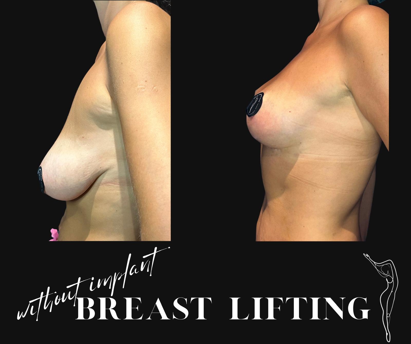 How is Breast Lift (Mastopexy) Surgery Done? Recovery after Breast Lift in turkey, antalya