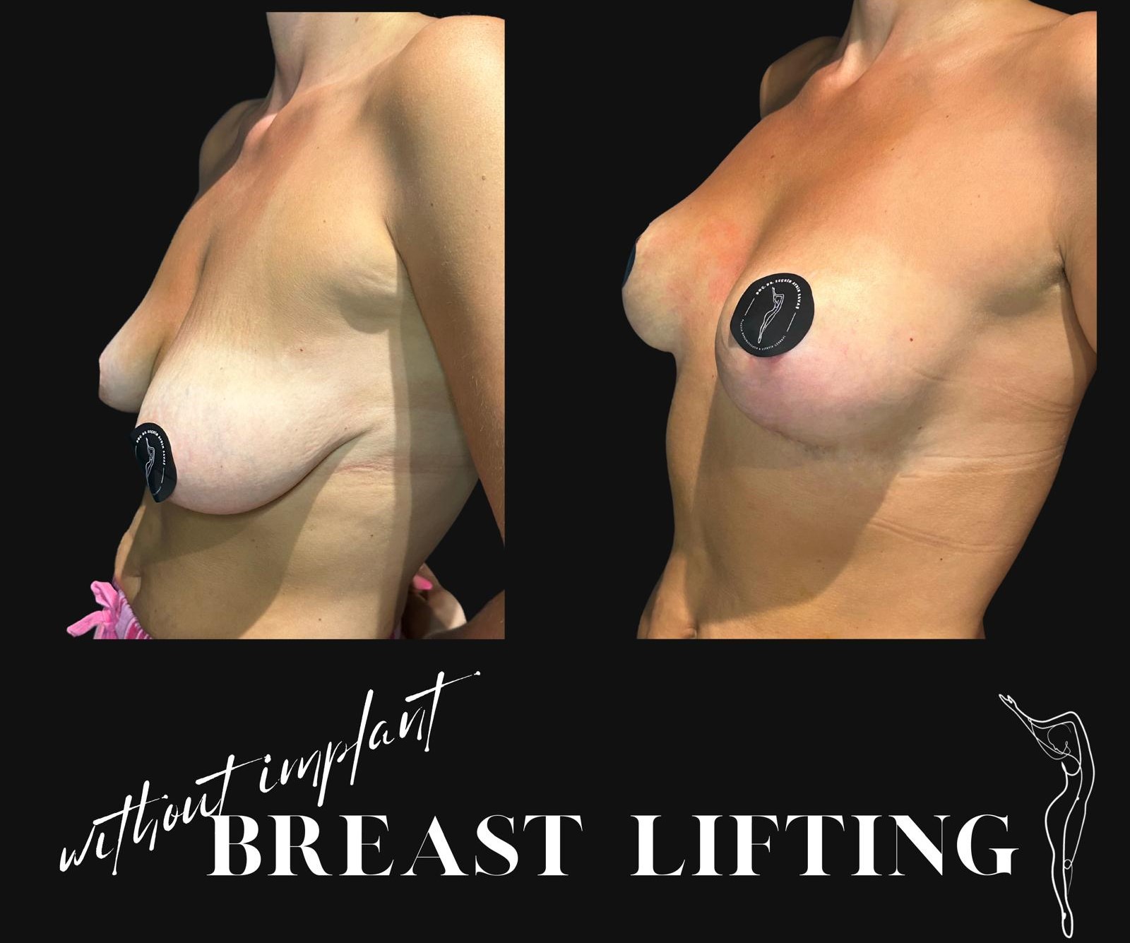 How is Breast Lift (Mastopexy) Surgery Done? Recovery after Breast Lift in turkey, antalya