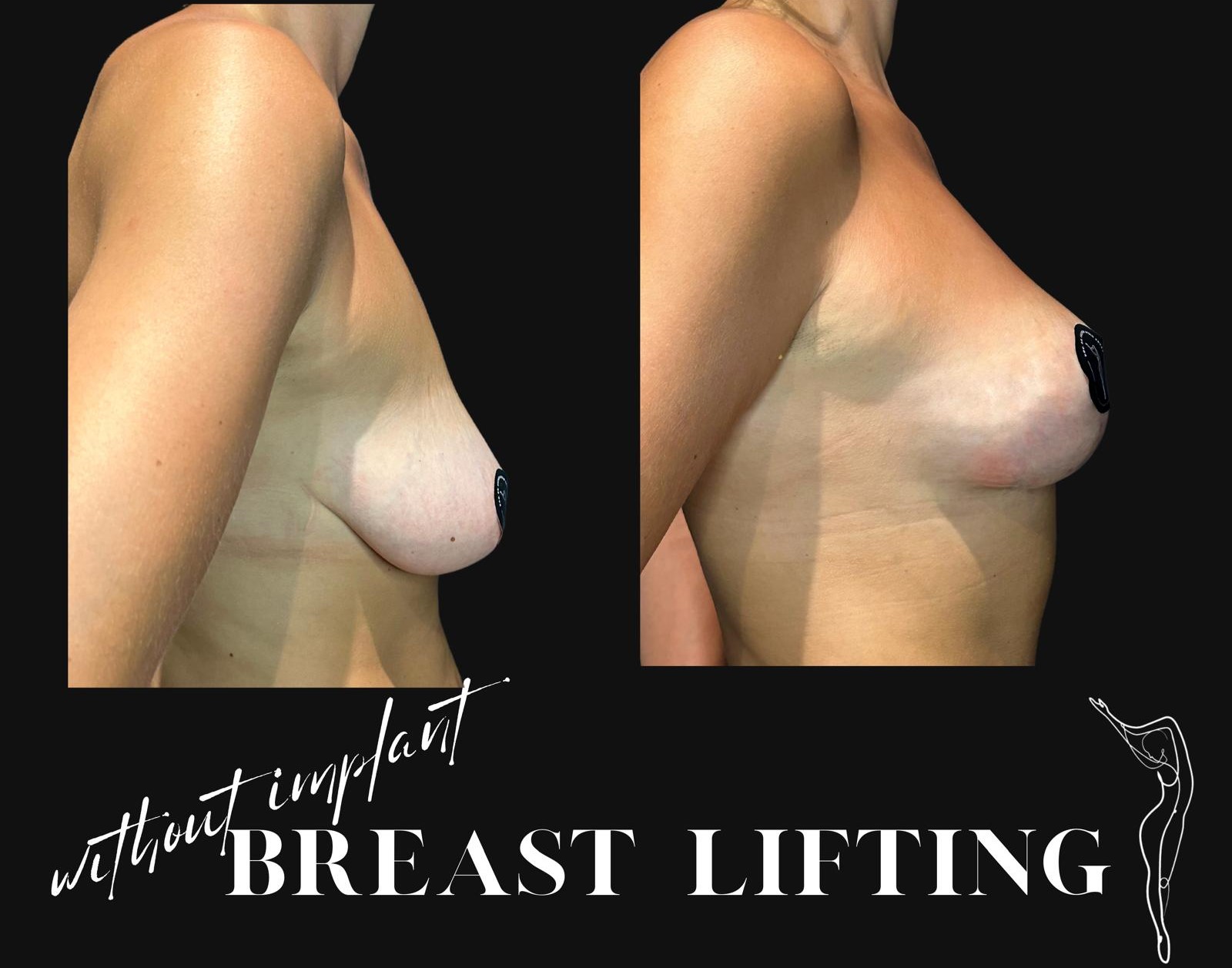 How is Breast Lift (Mastopexy) Surgery Done? Recovery after Breast Lift in turkey, antalya