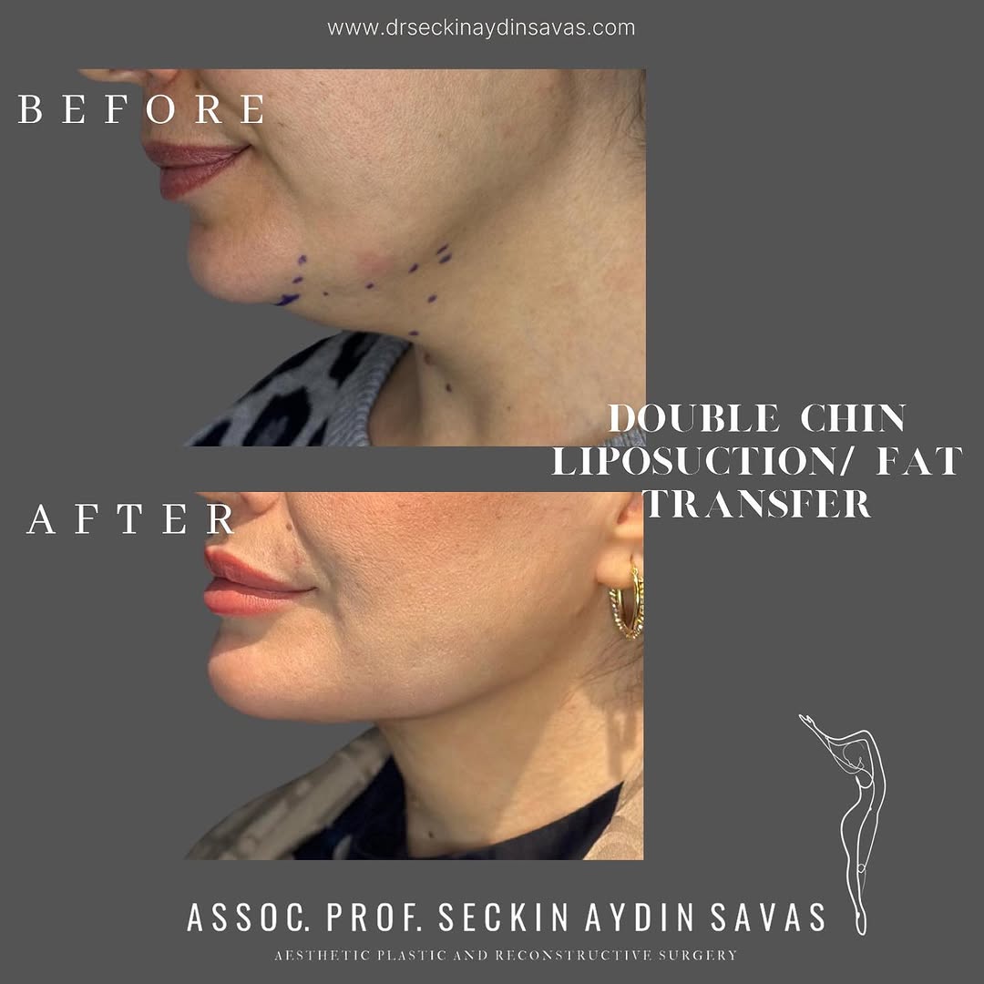 Double chin liposuction-1 in Turkey, Antalya?