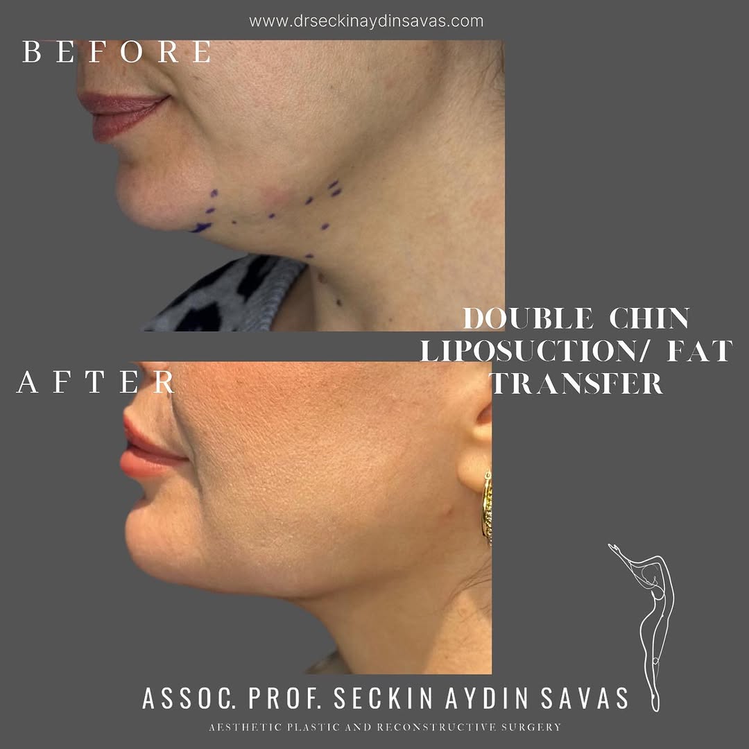 Double chin liposuction-2 in Turkey, Antalya?