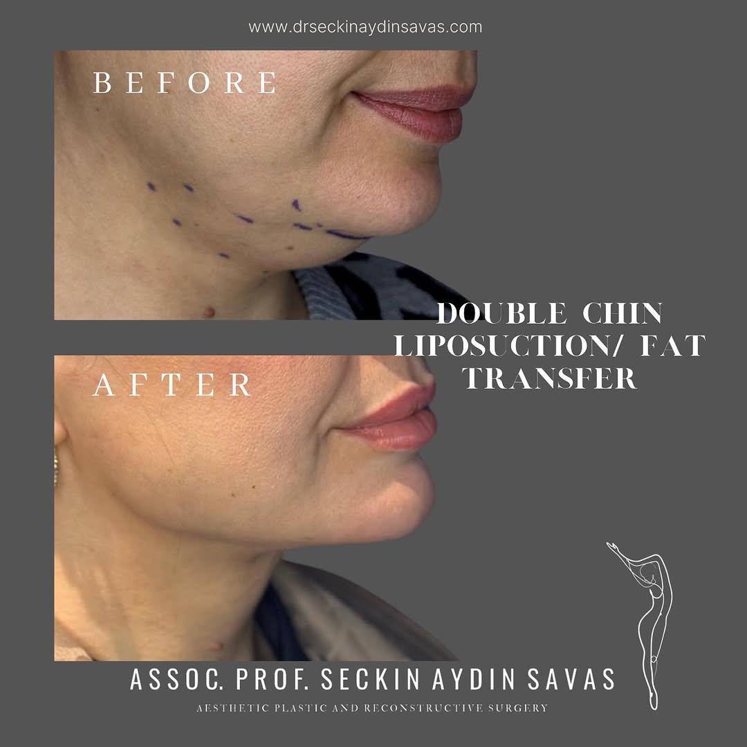 Double chin liposuction-3 in Turkey, Antalya?