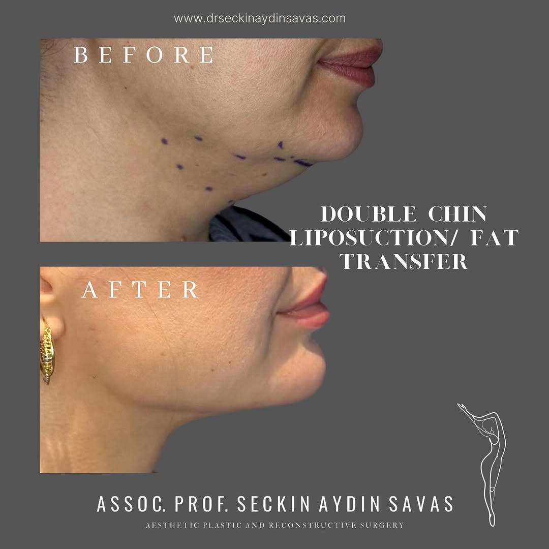 Double chin liposuction-4