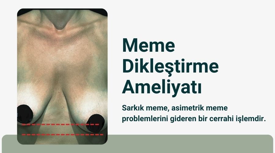 Emzirme sonrası memede sarkma Antalya