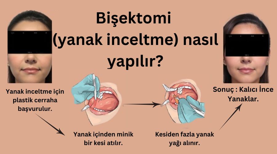 Bişektomi nasıl yapılır? Antalya